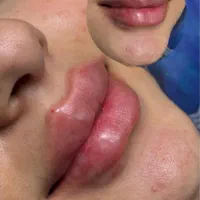 تزریق ژل و بوتاکس و شاین بادی|خدمات زیبایی و سلامت|تبریز, |دیوار