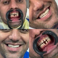 کامپوزیت دندان طرح لبخند ، جرمگیری، پالیش، بلیچینگ|خدمات زیبایی و سلامت|اهواز, زیتون کارمندی|دیوار
