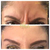 تزریق بوتاکس و فیلر با تخفیف ویژه|خدمات آرایشگری و زیبایی|قزوین, |دیوار