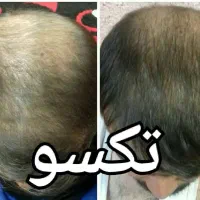 چربی سوزی ولاغری وزیبایی صورت|آرایشی، بهداشتی، درمانی|ایلام, |دیوار