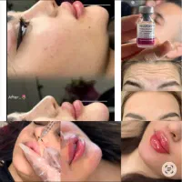 تزریق ژل و بوتاکس (تکنیک M)