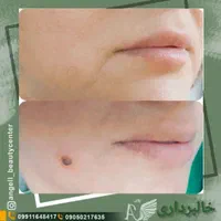 لاغری شکم پهلو ران بازو لیفت سینه و مزو تراپی|خدمات آرایشگری و زیبایی|تهران, سبلان (لشگر)|دیوار