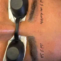 پاک کردن تتو با لیزر کیوسوییچ تضمینی