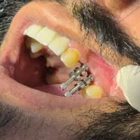 صفرتاصد خدمات دندانپزشکی به صورت اقساطی|خدمات آرایشگری و زیبایی|بوشهر, |دیوار