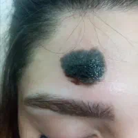 برداشتن زگیل و خالهای مجاز ب روش طب سنتی