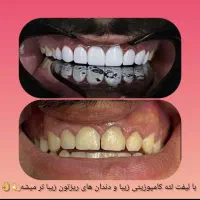 کامپوزیت فقط فکی ۱۶ تومن وآموزش  روز کامپوزیت