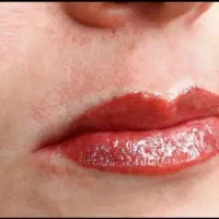 میکرو بلدینگ، فیبروز، شیدینگ