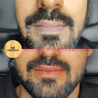 میکروبلیدینگ ابرو/رفع تیرگی لب/اسکالپ سر|خدمات آرایشگری و زیبایی|تهران, نیاوران|دیوار