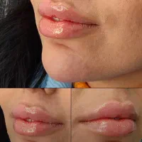 ژل و فیلر لب و صورت توسط پزشک