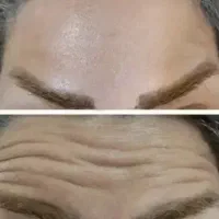 تزریق ژل بوتاکس درکلینیک