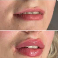 تزریق ژل و بوتاکس