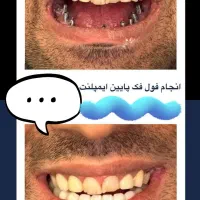 ایمپلنت تخصصی از ۷میلیون+ اوردنچر/ تخفیف تاآخرآذر|خدمات آرایشگری و زیبایی|اصفهان, جلفا|دیوار