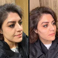 تزریق ژل و بوتاکس