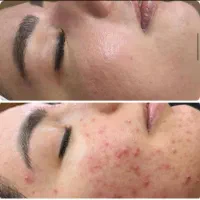آموزش،فیشیال،پاکسازی تخصصی،جوانسازی صورت بانوان|خدمات آرایشگری و زیبایی|کرمانشاه, |دیوار