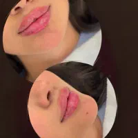 تخفیف تزریق ژل وبوتاکس|خدمات آرایشگری و زیبایی|آمل, |دیوار