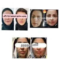 پکیج چاقی ۱۰۰ درصدی صورت
