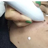 حذف انواع خال های پوستی و گوشتی و کک مک