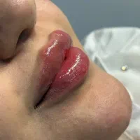 بوتاکس فیلر تخصصی و فیلر بادی و پی ارپی