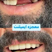 ایمپلنت فوری فقط۱۰۳۰۰/دندانپزشکی با اقساط۶-۱۵ماهه|خدمات آرایشگری و زیبایی|ملکان, |دیوار