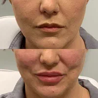 خدمات زیبایی صورت مزوتراپی بوتاکس فیلر|خدمات آرایشگری و زیبایی|شهریار, شهریار|دیوار