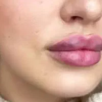 اف ویژه اموزش و خدمات فیلر و ژل بوتاکس کراتین خال|خدمات آرایشگری و زیبایی|دزفول, |دیوار