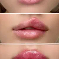 تخفیف ژل و بوتاکس ویژه فقط برای فردا