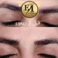 ریموو تک جلسه ای تضمینی|خدمات آرایشگری و زیبایی|مهران (ایلام), |دیوار