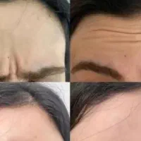 تزریقات زیبایی|خدمات آرایشگری و زیبایی|قرچک, مهدیه|دیوار