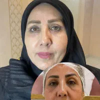 بلفاروپلاستی ، ژل ، بوتاکس