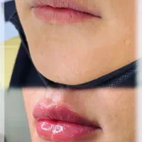 تخفیف عیدانه تزریق ژل،بوتاکس،فشیال.لیزر|خدمات آرایشگری و زیبایی|تهران, نیروی هوایی (پیروزی)|دیوار