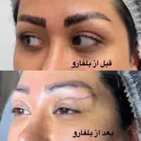 بلفارو روباهی در کلینیک مهرزاد