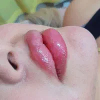 خدمات تخصصی فیلر و بوتاکس در رشت|خدمات آرایشگری و زیبایی|رشت, گلسار|دیوار