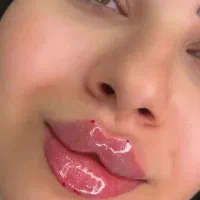 تزریق ژل وبوتاکس به همراه مزوتراپی