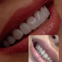 کامپوزیت دندان بابهترین برند اورجینال وشرکتی