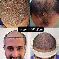 مرکزکاشت مو/ابرو دنا/تیم کاشت بینالمللی(غیربومی)