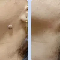 از شر خال‌های گوشتی خلاص شو