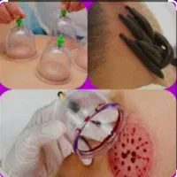 آموزش کارگاهی صفر تا صدحجامت و زالو درمانی|خدمات آموزشی|ارومیه, |دیوار