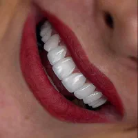 دنتال آلیس کامپوزیت و لمینت