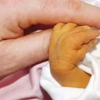 حجامت برای زردی نوزاد