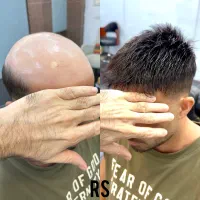 پروتز مو طبیعی زیبایی و اعتماد بنفس