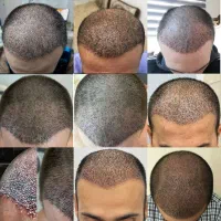 کاشت مو VIP - اقساطی