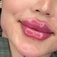 ژل وبوتاکس لب چانه زاویه خط لبخندآنزیم مزوسرفقط350