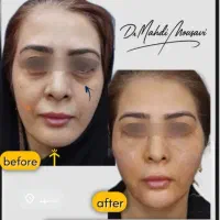 مرکز تخصصی تزریق فول فیس چربی و فیلر/لیفت با نخ|خدمات آرایشگری و زیبایی|مشهد, هنرستان|دیوار