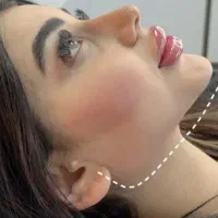 ژل 'بوتاکس'مزو