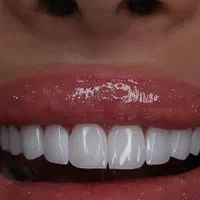 ایمپلنت فوری/روکش/کامپوزیت زیبایی/عصب کشی/|خدمات آرایشگری و زیبایی|تهران, مهران (سیدخندان)|دیوار