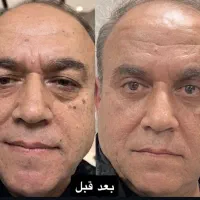 جراحی پلک پایین