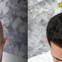 کاشت مو و ابرو با بهترین کیفیت و نازلترین قیمت