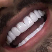 خدمات دندانپزشکی/ایمپلنت،لمینیت،کامپوزیت/اقساطی