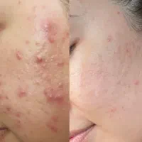 درمان جوش صورت و بدن|خدمات آرایشگری و زیبایی|دوگنبدان, |دیوار