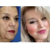 مدل برای جوانسازی و زیباسازی صورت لیفت و رفع لک